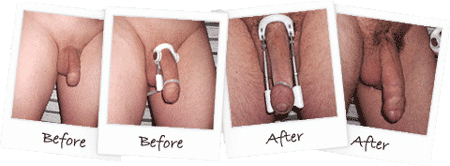 penile extender before and after