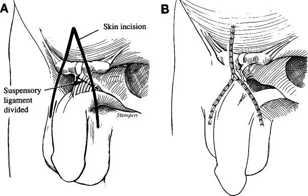 Suspensory Ligament Detachment