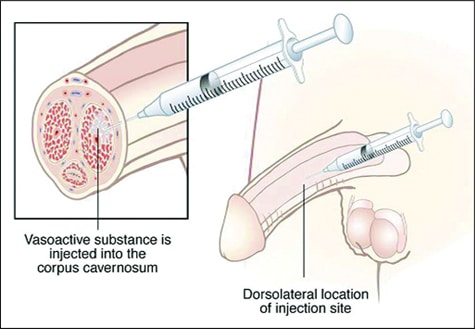 penile free fat transfer injections