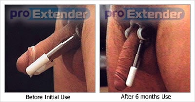 ProExtender before and after results